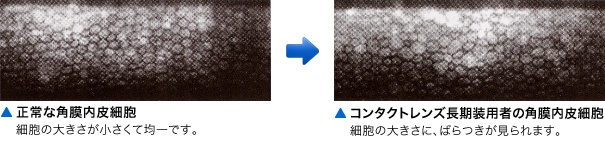 正常な角膜内皮細胞は細胞の大きさが小さくて均一です。コンタクトレンズ長期装用者の角膜内皮細胞は細胞の大きさにばらつきが見られます。