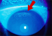 点状表層角膜症の写真