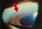 角膜新生血管の写真