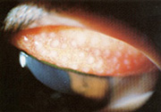 巨大乳頭結膜炎の写真