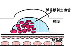 図1-A 光線力学的療法