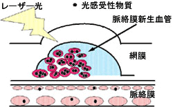 図1-B 光線力学的療法