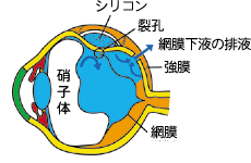 網膜剥離の手術の図解