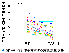 図5-A 硝子体手術による黄斑浮腫改善