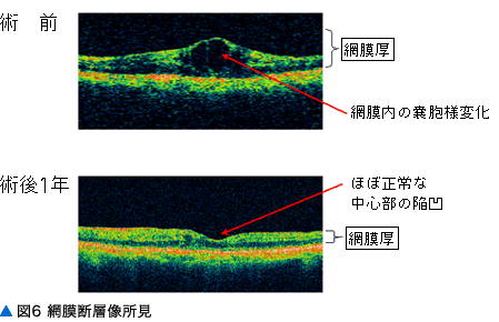 図6 網膜断層像所見