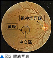 図3 眼底写真