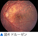 図4 ドルーゼン