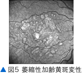 図5 萎縮性加齢黄斑変性