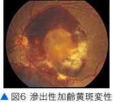 図6 滲出性加齢黄斑変性