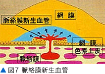 図7 脈絡膜新生血管