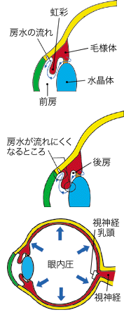 緑内障の図解