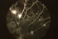 蛍光眼底血管撮影の写真