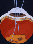 レーザー網膜光凝固の図解